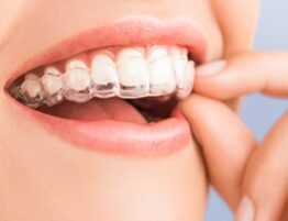 Dr Taller Dental Your Dentist In Riverdale in the Bronx NY Invisalign image