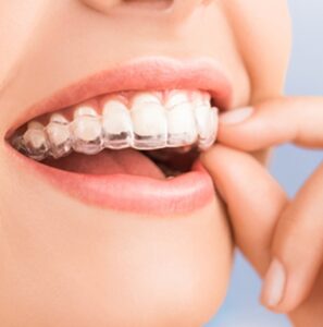 Invisalign image Clear Orthodontic Aligners Dr. Taller Dental