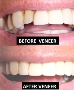 VeneerBEFORE AND AFTER Clear Orthodontic Aligners Dr. Taller Dental