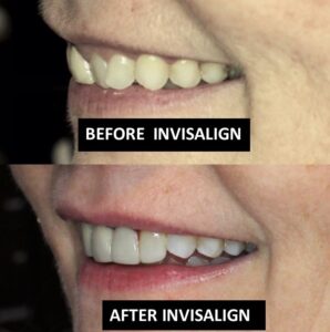 iNVISALIGN 1 BEFORE AND AFTER Clear Orthodontic Aligners Dr. Taller Dental