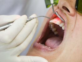 laser teeth whitening Dr. Taller Dental