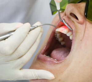 laser dental bonding Dr. Taller Dental