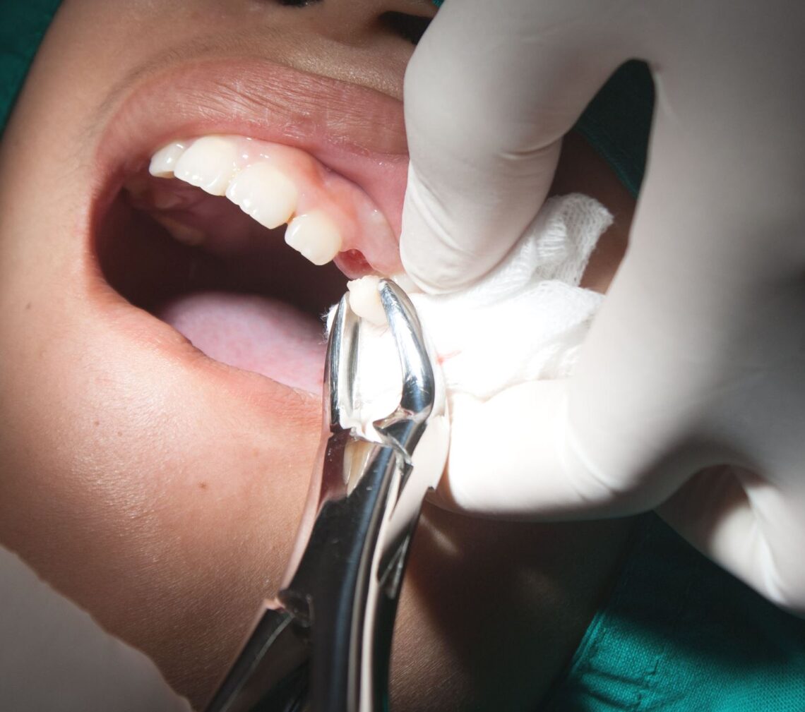 Dr Taller Dental Your Dentist In Riverdale in the Bronx NY tooth extraction image