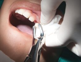 Dr Taller Dental Your Dentist In Riverdale in the Bronx NY tooth extraction image