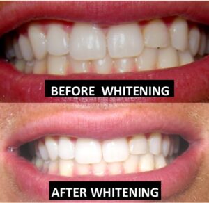 whitening BEFORE AND AFTER teeth whitening Dr. Taller Dental