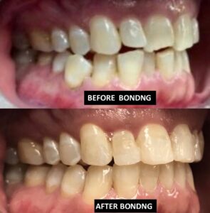 Bonding BEFORE AND AFTER dental bonding Dr. Taller Dental