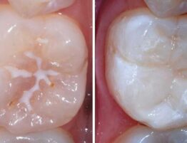 Sealant Bleeding Gums Dr. Taller Dental